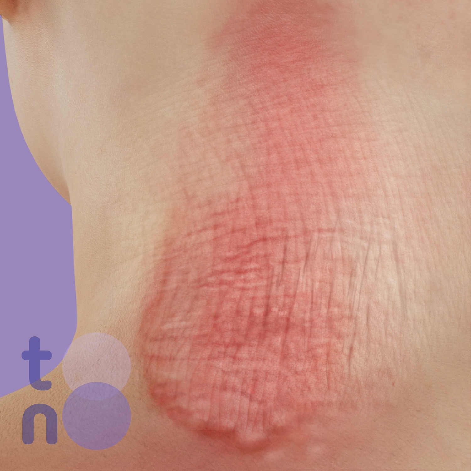 Lichenification close-up