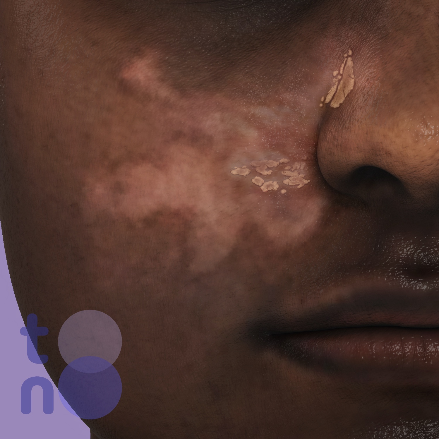 Hypopigmentation close-up