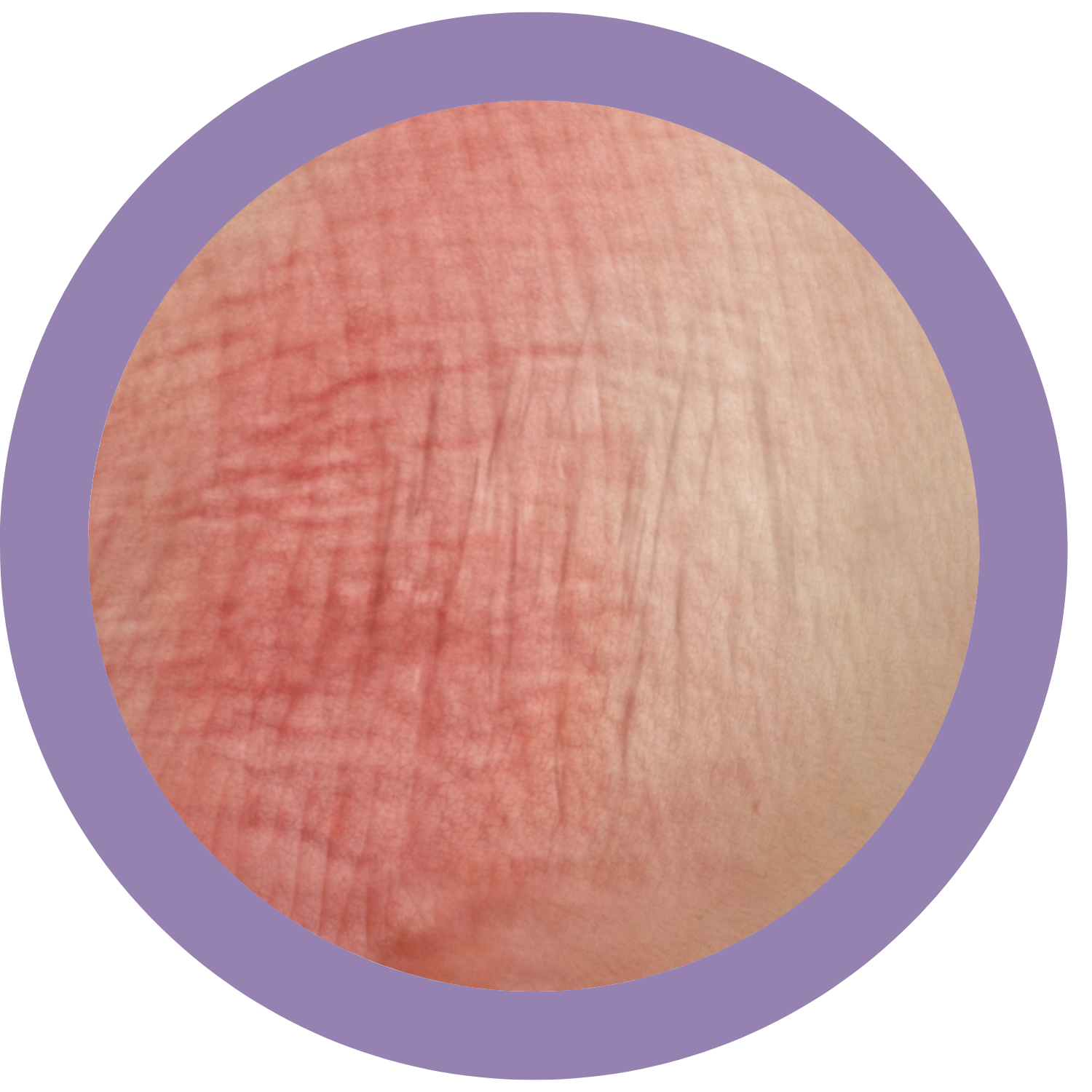 Lichenification example