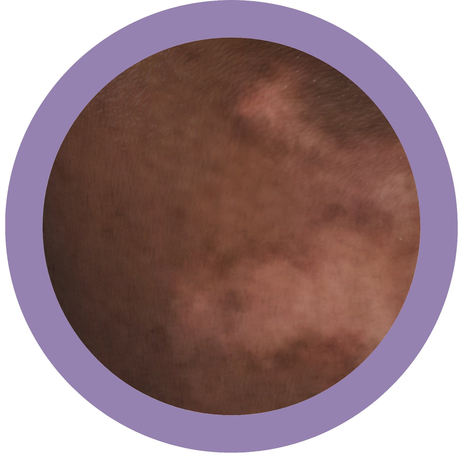 Hyperpigmentation example