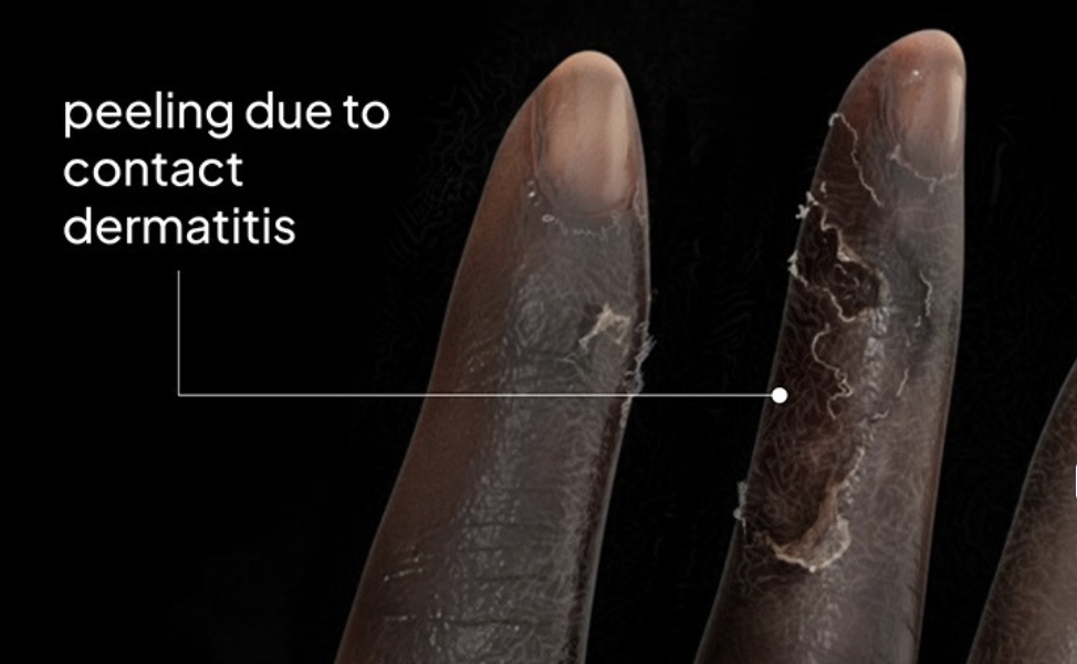 Eczema across tones from mild to severe